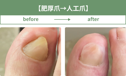 肥厚爪を人工爪にして改善した事例(1)