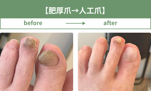 肥厚爪を人工爪にして改善した事例(2)