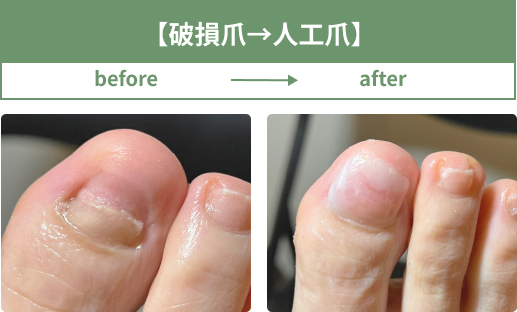 破損爪を人工爪にして改善した事例