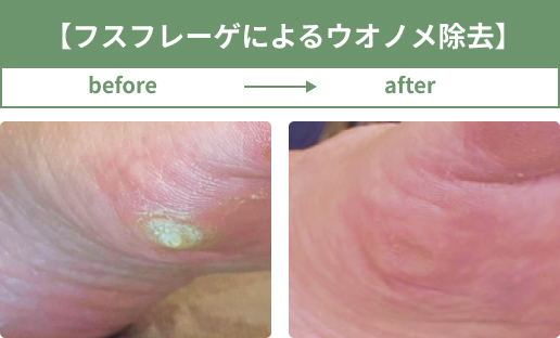 フスフレーゲによるウオノメ除去
